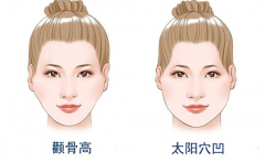 颧骨内推后,面部皮肤一定会下垂吗？看完秒懂