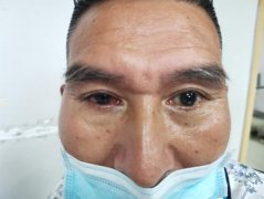 以吾之黑暗换汝之光明  男子因眼疾被迫摘眼球 捐献眼角膜传递光明